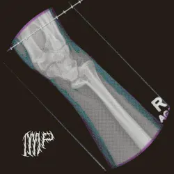 Fractured